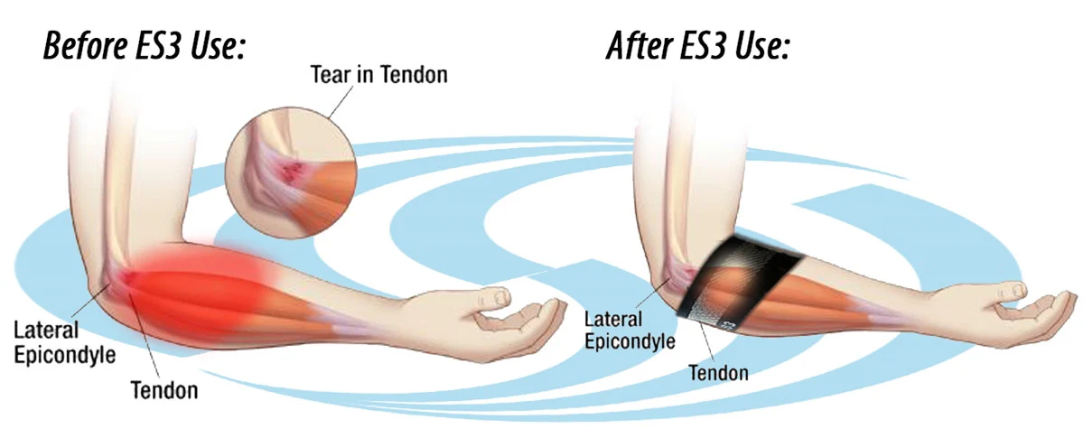Compression Elbow Sleeve ES3 - Image 3